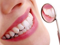 Metode pemutihan gigi dengan bleaching beserta manfaat dan efek sampingnya