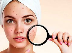 intense pulsed light ipl for acne treatments benefits